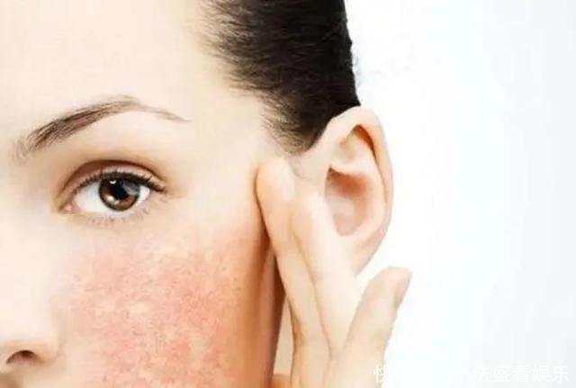 别人刷酸是蛋壳肌,你刷酸就烂脸?原因其实在这里