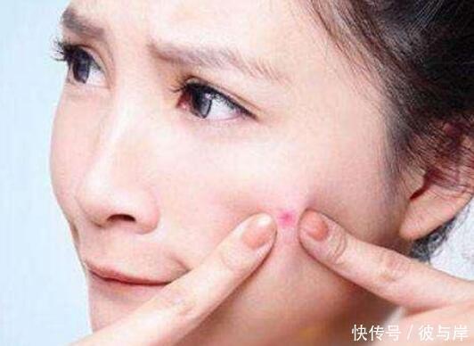 去痘印|长痘不留印,一定要养成这些好习惯,但只有少数人能做到