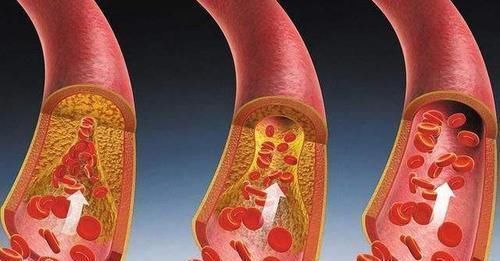 教你2个办法，让血管内的“斑块”轻松消除，或许血液会感谢你