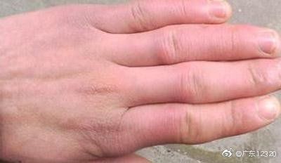 局部|冻伤后不及时处理会产生什么后果？