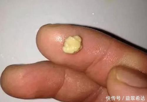 儿子因“口臭”被同学嫌弃，带孩子检查，取出来的颗粒果然很臭