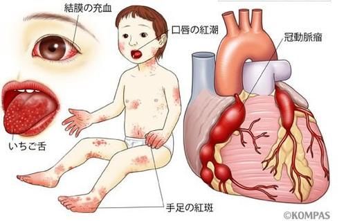 把这个病当普通感冒治，后果很严重！