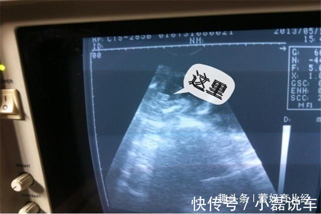 侥幸心理|女子怀孕7个月,胎儿突然停止胎动?“嘴馋”或成罪魁祸首