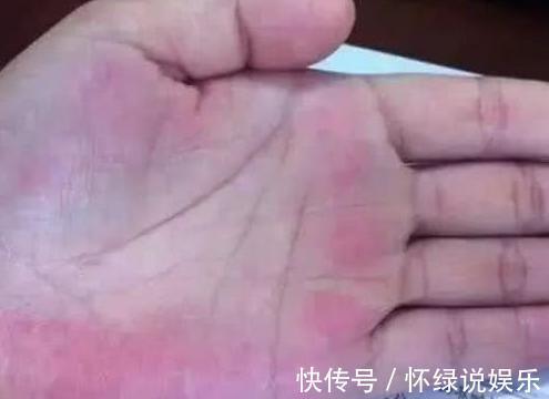 病变|如果你身上出现了2种痣,可能是肝脏病变,不注意就迟了