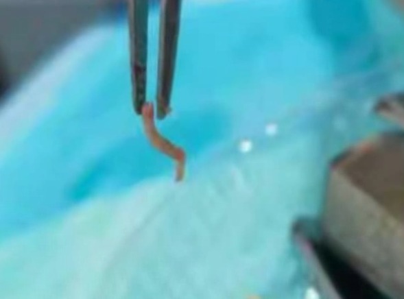 口腔|小伙牙疼去拔牙,揪出1厘米长活虫