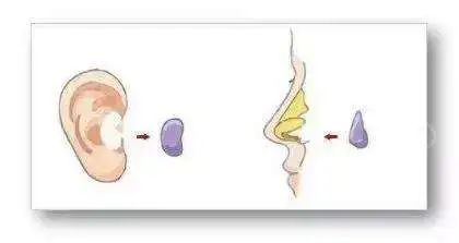 特点|耳软骨(自体)隆鼻的7个特点丨科普篇