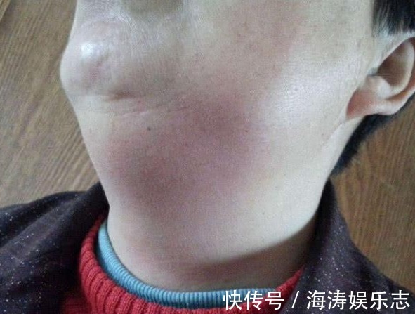 會長|一旦染上艾滋病，無論男女，嘴巴會長出一種“記號”