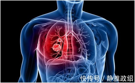肺癌|肺癌患者学习晚期癌症扩散后，做几件事就能保住你的命