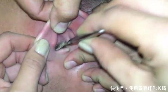 打耳洞|女孩打耳洞后长出鸡蛋大“肉球”,医生提醒打耳洞要注意两点