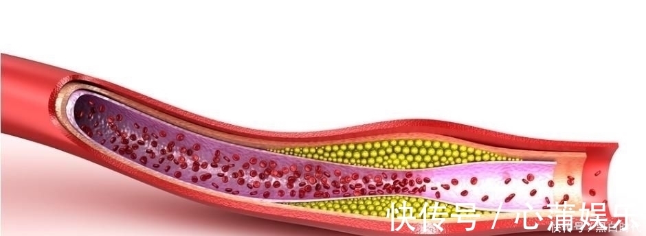 高血脂|心血管专家建议开水里加1勺，连喝15天，洗净血管，降低高血脂