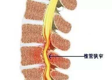 疼痛科|真的吗？背上打个孔，十多年的腰腿痛就好了