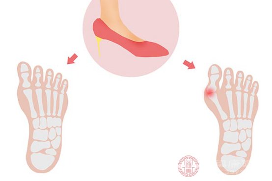 拇外翻怎么办