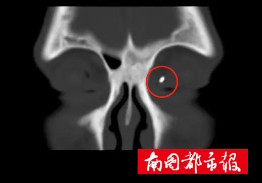 异物|一颗“铁豌豆”在乐东男子眼睛里藏了3年，他竟浑然不知！