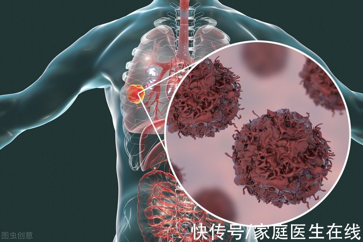 卵巢癌|得了癌症就=短命？别乱想，有4个特征，或轻易跨过5年