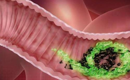  混淆|别把肠癌和痔疮弄混淆了, 今天教你如何区分它们!