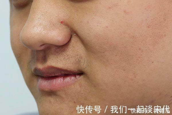 皮下出血|肺癌早期，总是不痛不痒提醒皮肤有“突变”，及时做检查