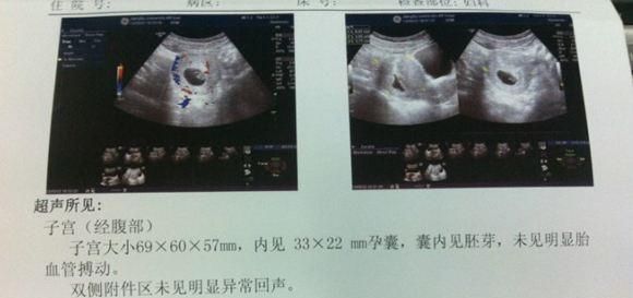 孕45天发现怀孕，孕妈尽快进行这项检查，了解这些情况很重要