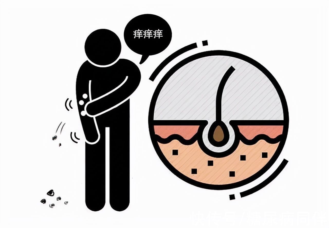 口服降糖药|糖尿病人血糖高，晚上身体会有四个症状