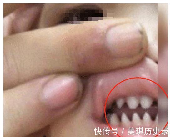宝妈|3岁男孩长出“鲨鱼牙”,妈妈着急送医检查,医生:无知的父母