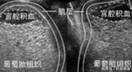 到底|葡萄胎到底是什么?怀孕期出现葡萄胎该怎么办?