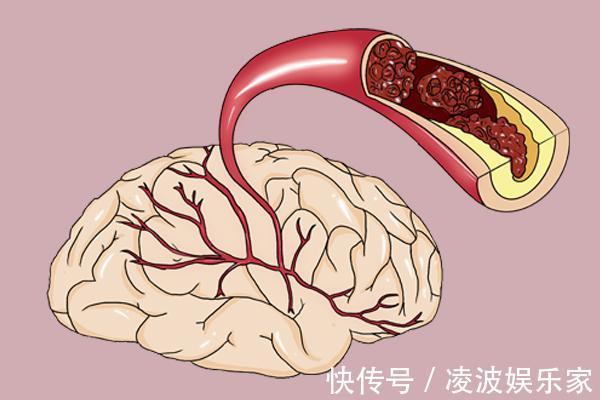 脑梗|脑梗来临,头部先知道!头部出现什么变化,要警惕脑梗