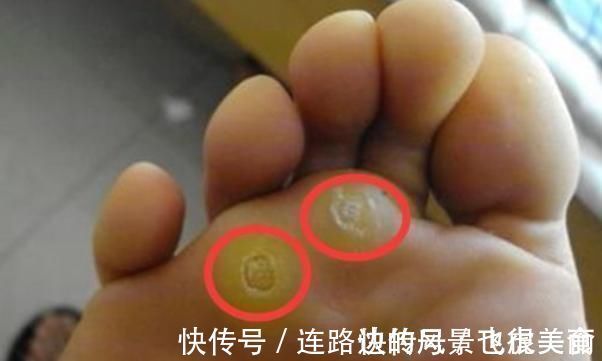 原来鸡眼是这么来的,四个小妙招,教你轻松解除多时的困惑!