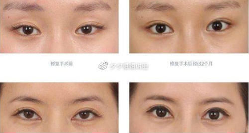双眼皮修复风险大吗，都有哪些方法？