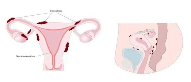 子宫内膜异位症|痛经一忍就是20多年，42岁女子忍到手术台上，还用上“骨凿”“骨锤”