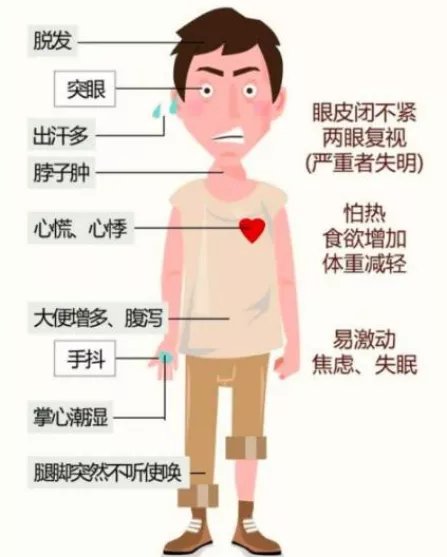 药物|怕热多汗、急躁易怒、多吃不胖，得了甲亢怎么办？专家告诉你3个治疗方法