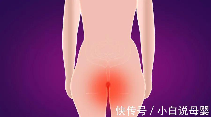 痔疮|老一辈人常用的消除痔疮的方法,在家就能缓解痔疮症状!