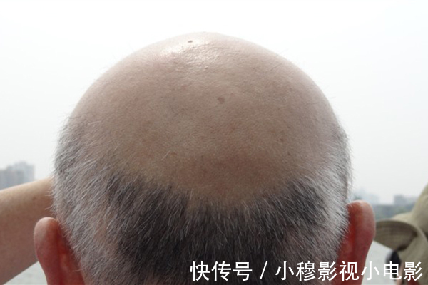 发物|为什么癌症患者容易疲劳？面对“癌性疲劳”，应该怎么办？