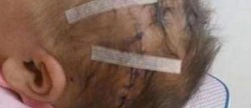 伤口|剖腹产划伤孩子头部,医生很快就会好的,7年后家长找上医院