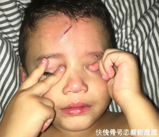 男孩不小心磕破了额头,宝妈灵机一动,让娃变成了“哈利波特”