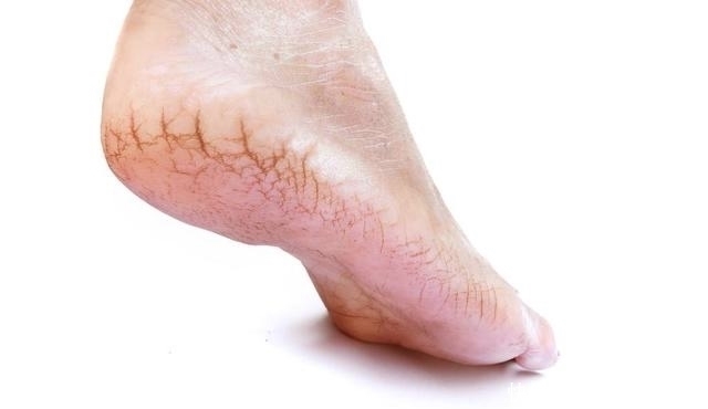 “脚后跟干裂”是什么原因导致的?你遇到过这种情况吗?别忽视!