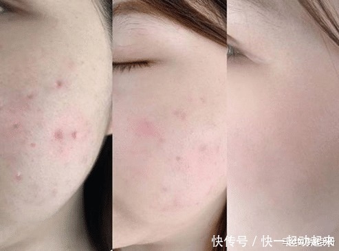 影响|爱挤痘痘的这些女星,现在皮肤都是什么样看这2个例子就知道了