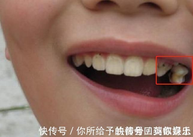 恒牙|6岁男娃长“双层牙”,老人的“坏习惯”害了娃,你家有这习惯吗