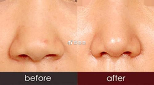 鼻综合中鼻头鼻翼缩小术的价格是多少?术后有哪些后遗症?