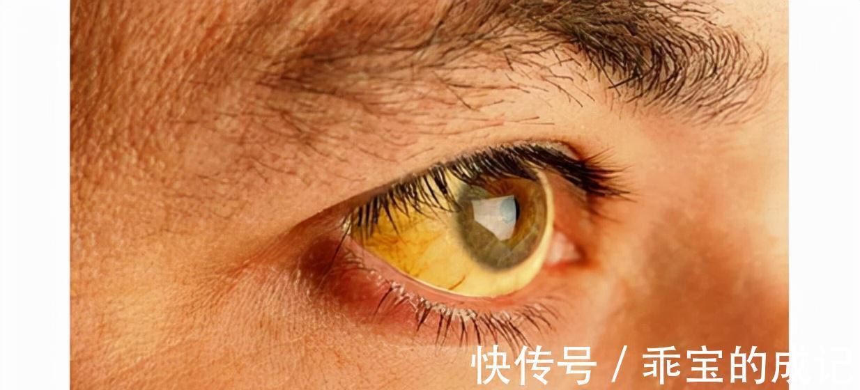 腹痛|胰腺癌被称为“癌王”？有6大类高危人群，有哪些典型的征兆？