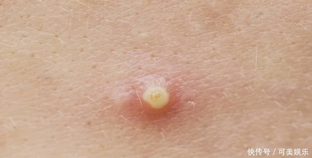 脂肪粒|又长痘痘了怎么办可以用手挤吗注意以下几点,还你洁白肌肤