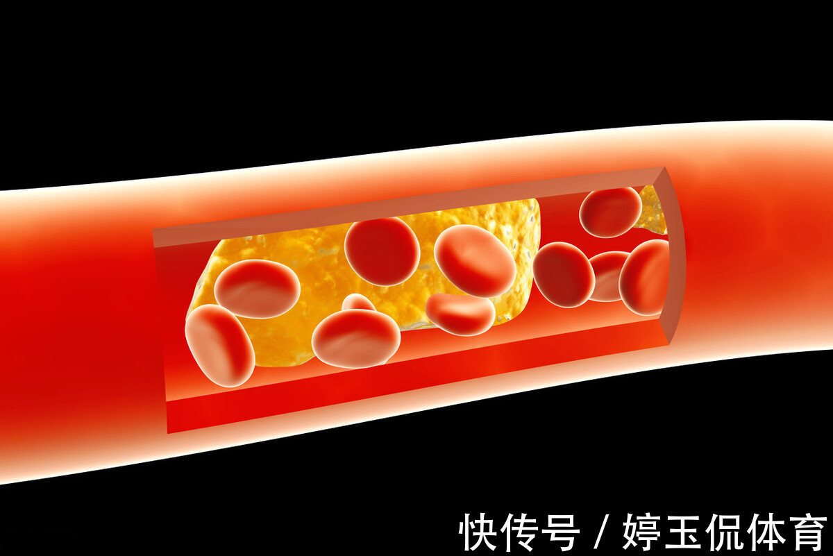 低密度脂蛋白|最新研究:控制饮食,来降低“坏血脂”,能大大节约医疗费用!