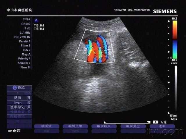 医生|胎儿突然没有动静，42岁妈妈紧急剖宫产，看到胎儿医生摇头