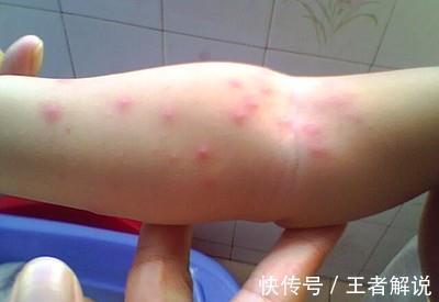 海鲜类|孩子皮肤过敏怎么办?家长们需要知道这些知识