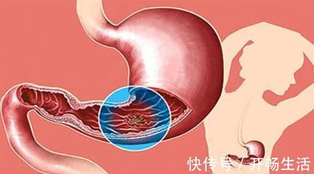 分期|“胃癌从早期到晚期”大概需要经历多长时间