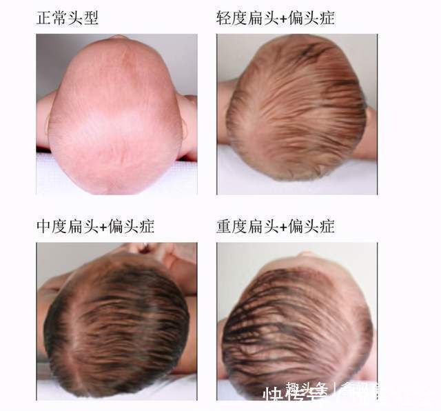 圆头|宝宝头型影响身高这种头型的宝宝有“大高个”潜力,父母别嫌丑
