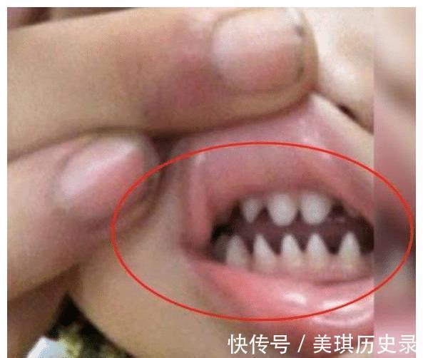 宝妈|3岁男孩长出“鲨鱼牙”,妈妈着急送医检查,医生:无知的父母