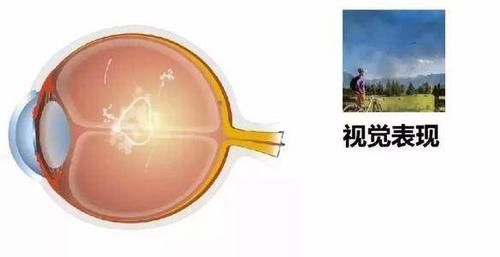 飞蚊症会致盲？医生：不是没有可能，遇到这种