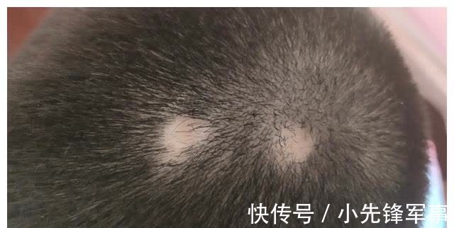斑秃|娃的头发是发育的“标准”,发多发少家长要有数,关乎宝宝的健康