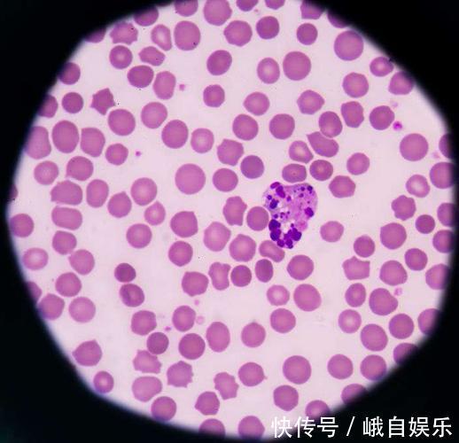 前列腺癌|癌症并非等于绝症,有4种癌就算到了晚期,也有治愈的可能