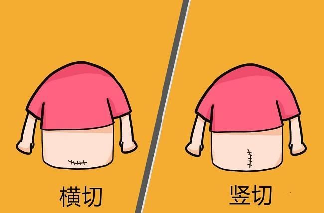 剖宫产中，横切口和竖切口有什么区别？