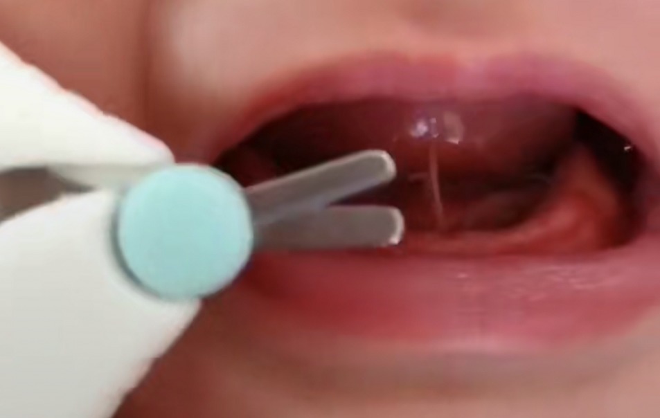 舌根|宝宝不剪“舌根”以后说话不利索?父母别信,很多孩子被害惨